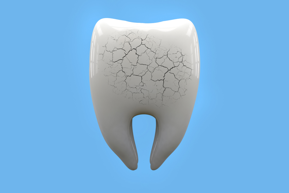 Can Teeth Whitening damage your Enamel