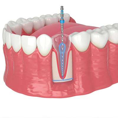 root canal