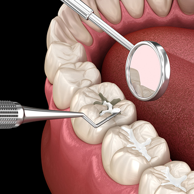 tooth-fillings
